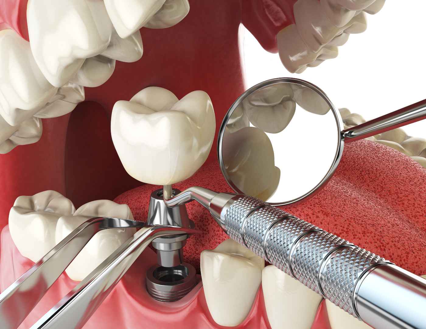 dental implants