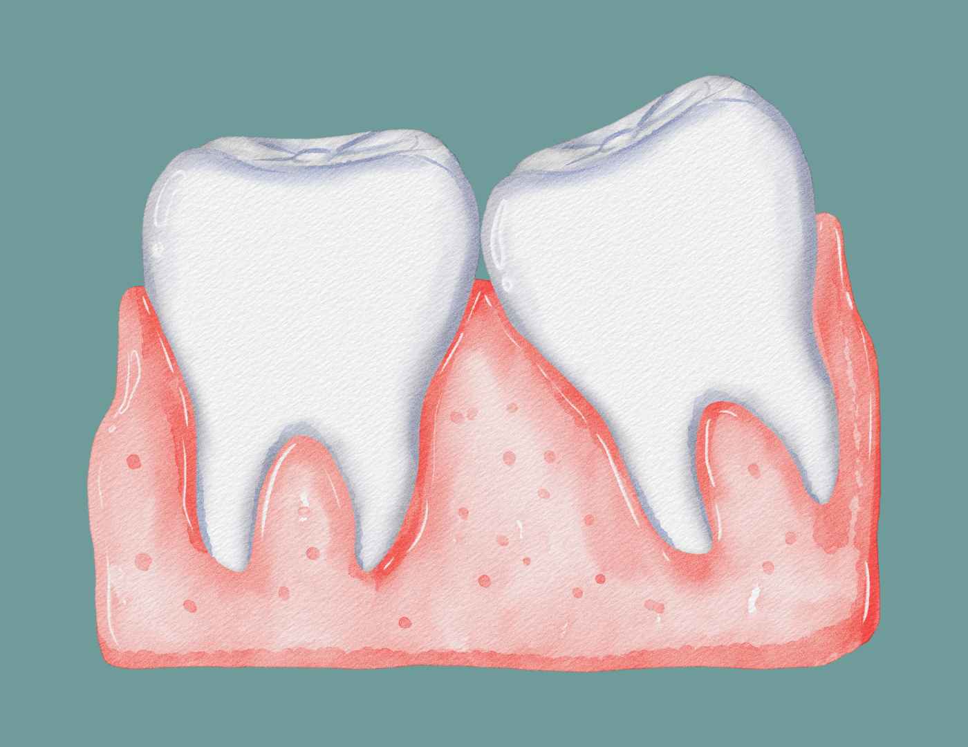why experts now say not to remove your wisdom teeth