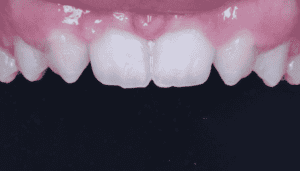 microdontia-small-teeth-genetics