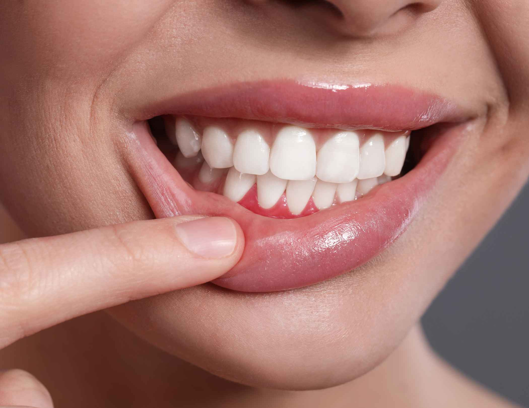 Inflamed Gums Causes & Treatments for Gum Swelling
