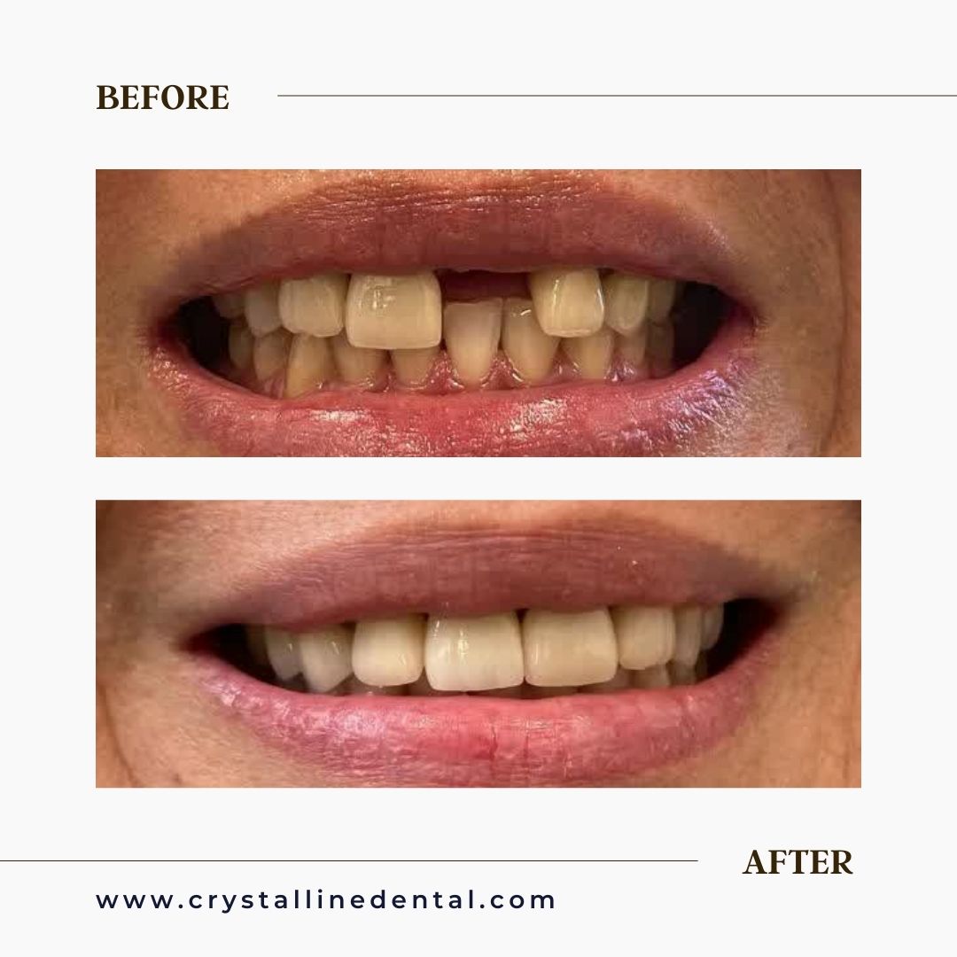 before and after photo of dental implant in Vaughan