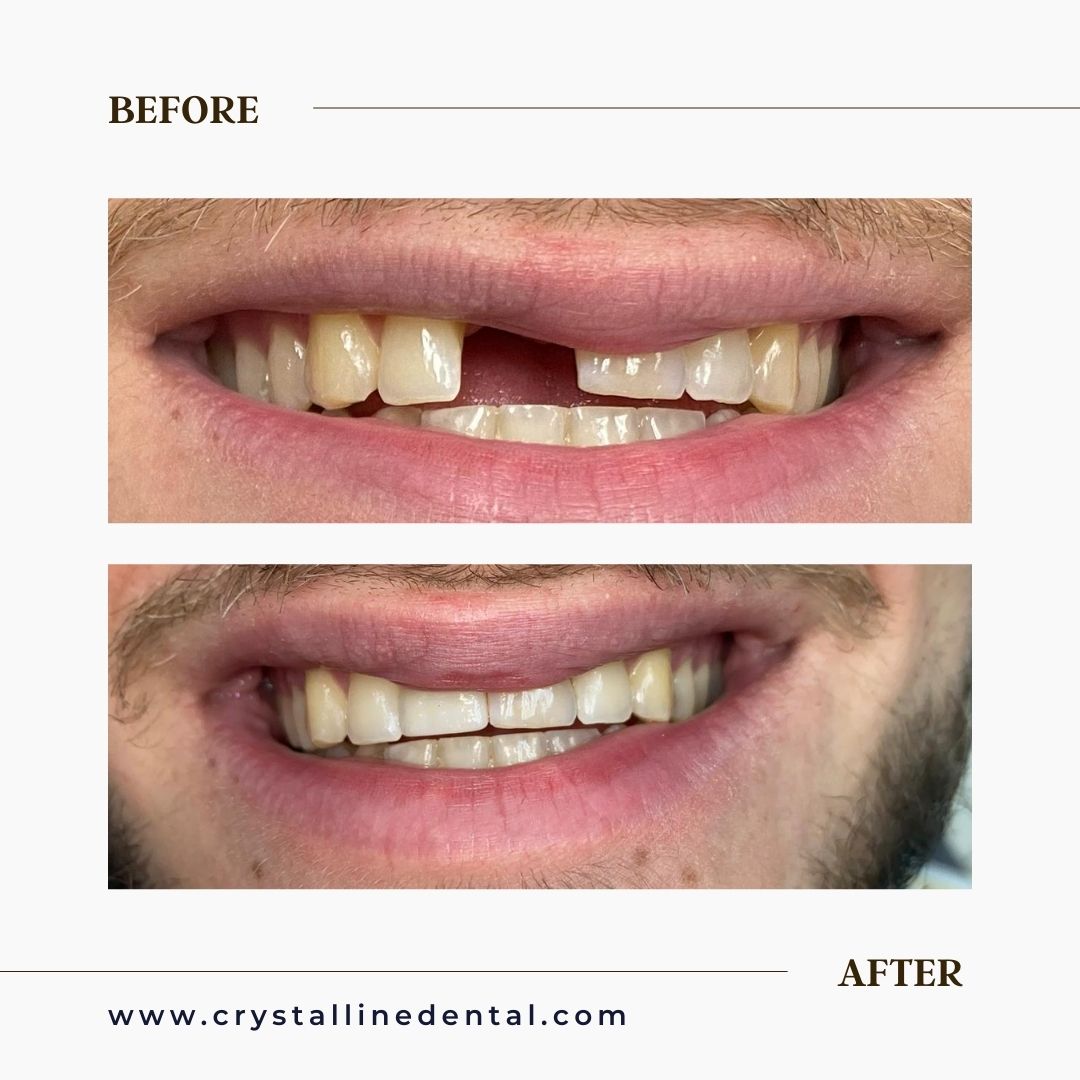 before and after photo of dental implant in Vaughan