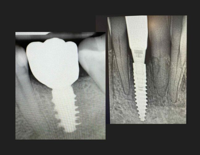dental implant in Vaughan