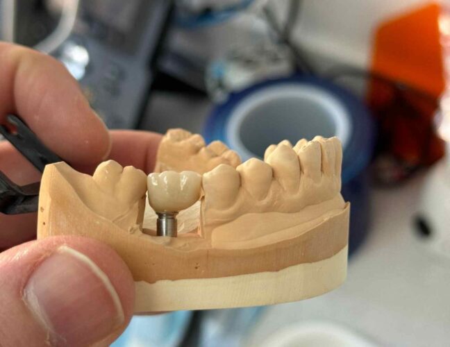 dental implant in Vaughan