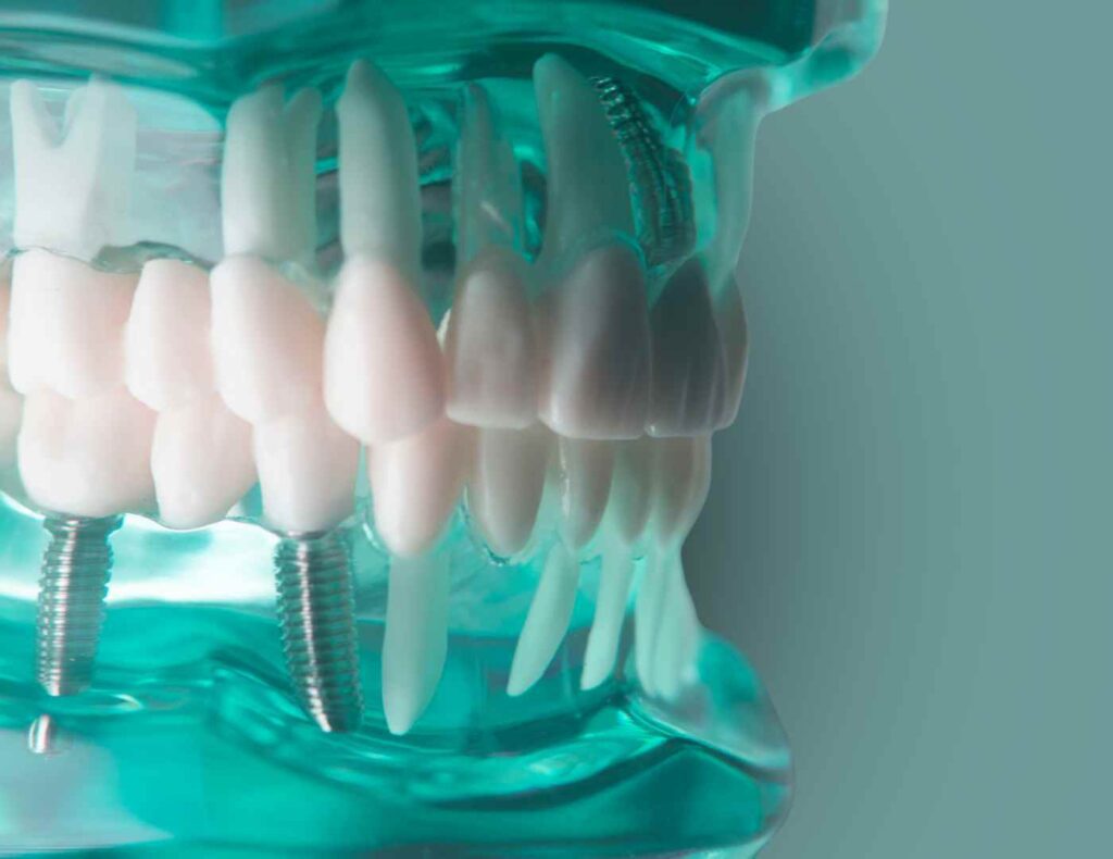 dental implant blue moulage