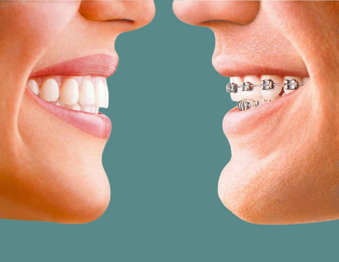 braces for buck teeth vs invisalign