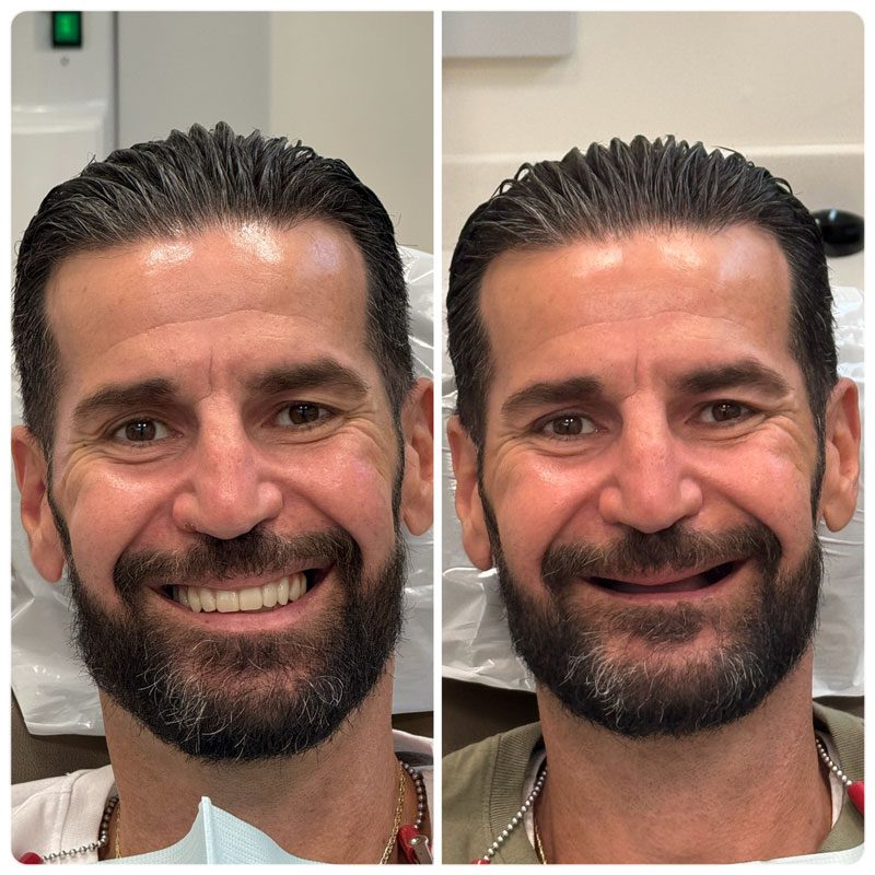 full arch implant