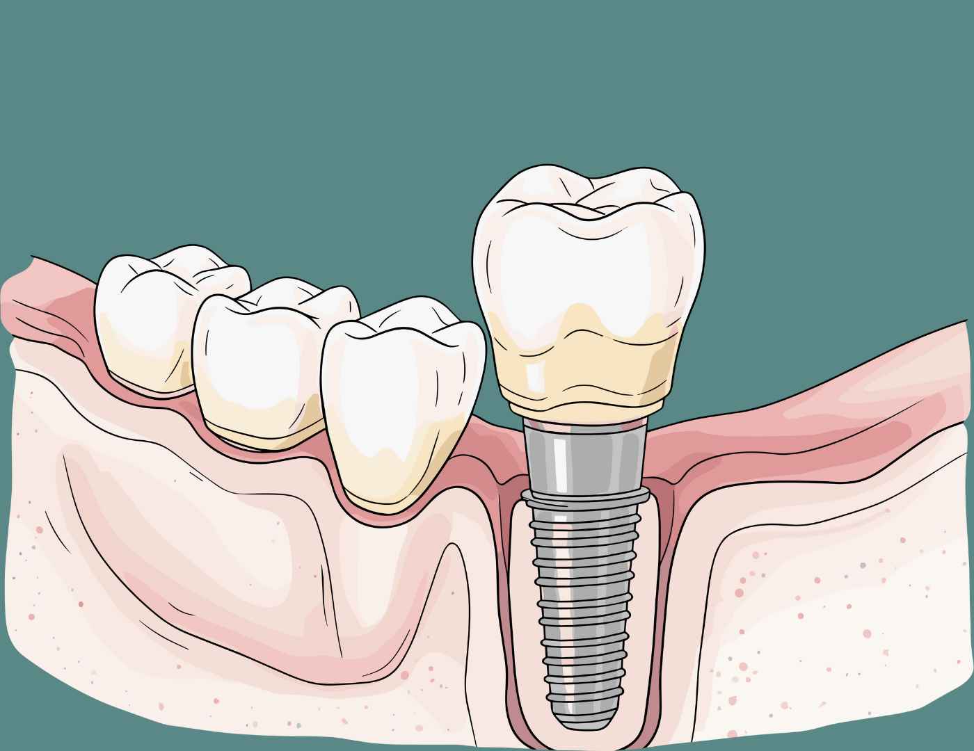 dental implants for jawbone preservation