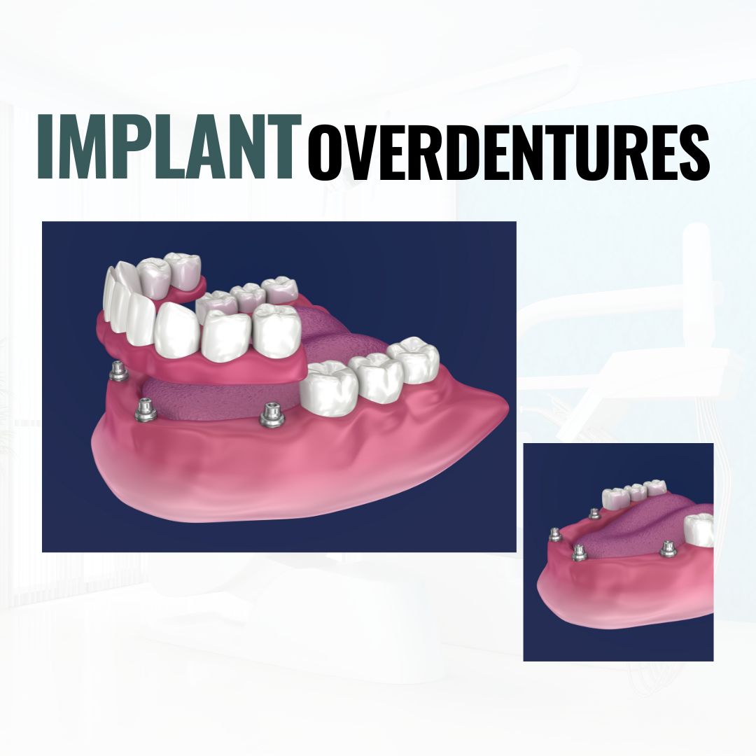 Implant Overdentures