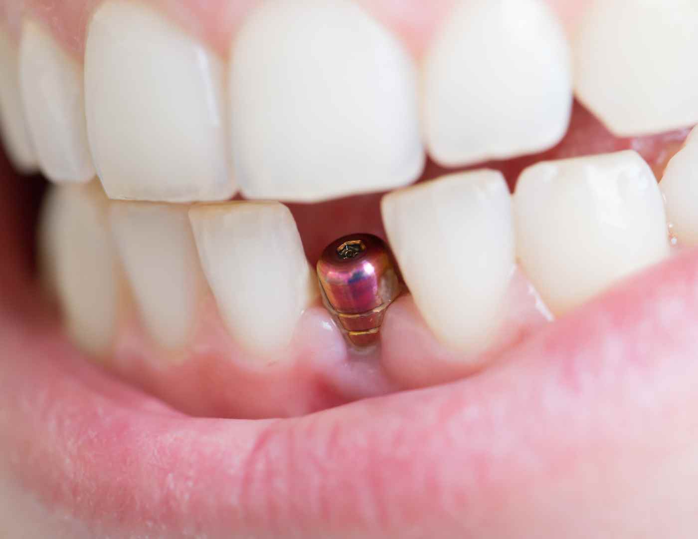 Dental Implant for Front Tooth
